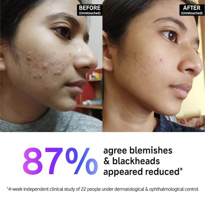 Acne com ácido salicílico + limpador de poros